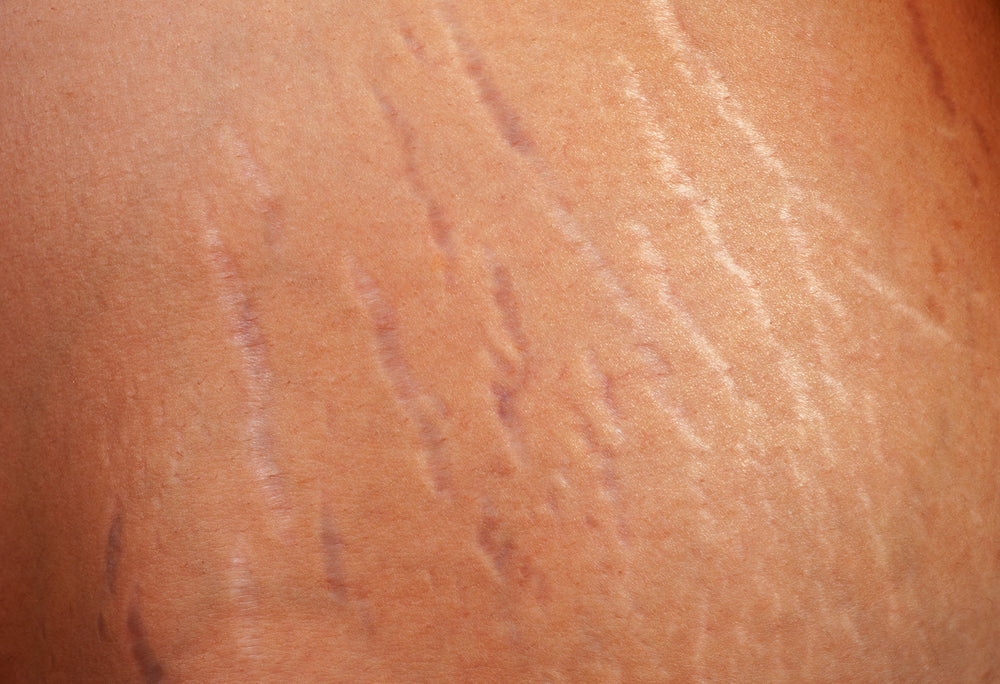 Unveiling Stretch Mark Secrets: Can Aloe Vera Help?