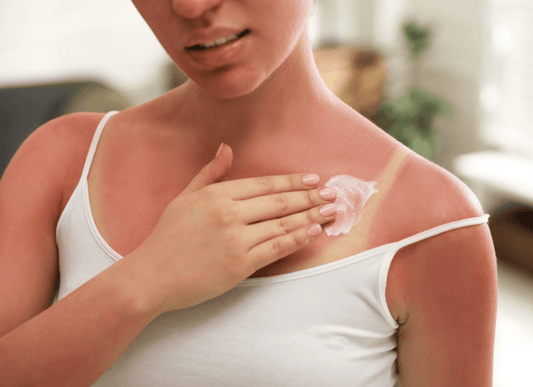 Aloe Vera the Ultimate Soothing Solution for Sunburns & Skin Irritations
