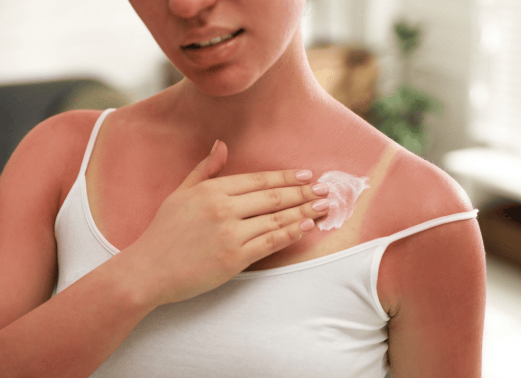 soothing solution for sunburns